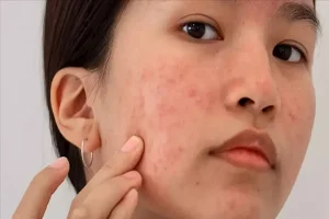  طرق علاجية للبقع الداكنة لدى المصابات بتكيس المبايض