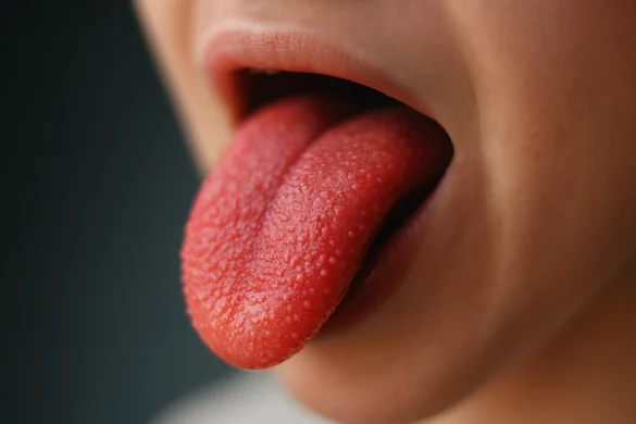 لسان الفراولة