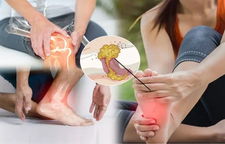 ما هي المشاكل الصحية الخطيرة المترتبة على ارتفاع حمض اليوريك؟