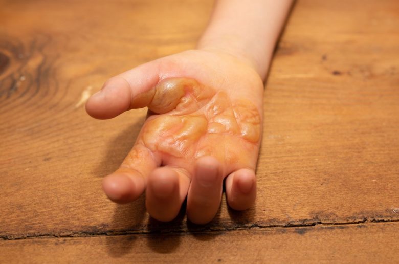 متلازمة الجلد المحروق