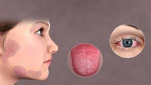 متلازمة شوجرن
