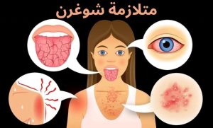 متلازمة شوجرن
