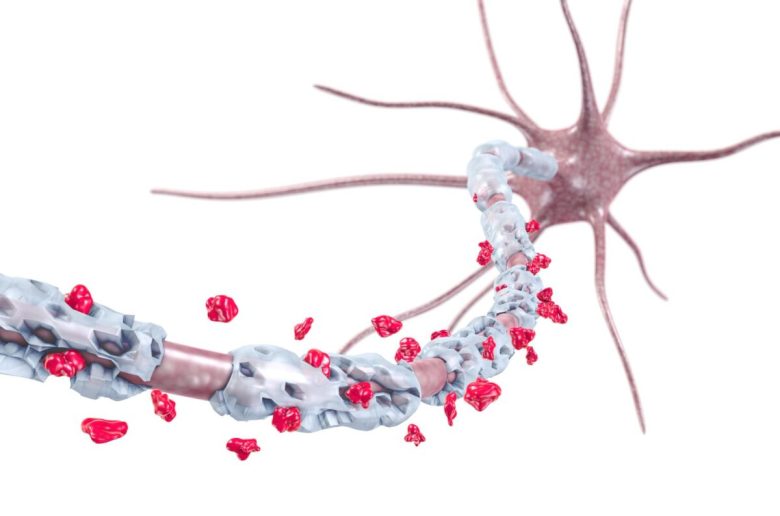 هجمات مرض التصلب المتعدد (ms) والتأتأة في الكلام