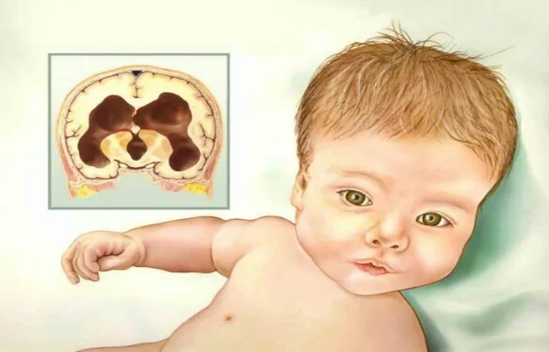 أزمة استسقاء الرأس عند الأطفال الصغار والكشف المبكر عنها