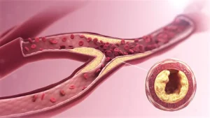 استئصال اللويحات الدموية