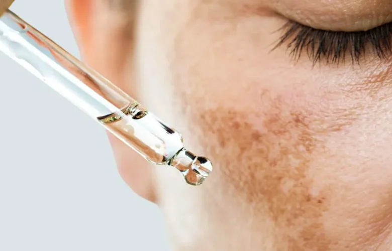 الأدوية المعنية بعلاج بفرط التصبغ الناتج عن التهابات البشرة والبثور