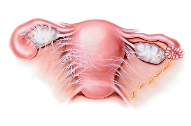 التصاقات الرحم التصاقات الرحم