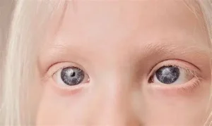 المهق العيني