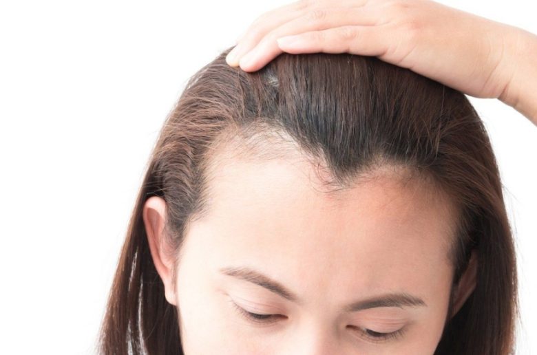 تساقط الشعر من الأمام تساقط الشعر من الأمام