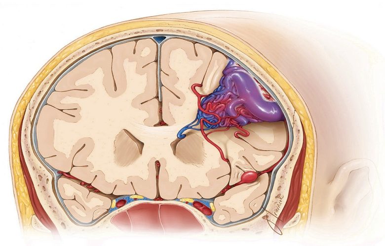 تشوهات الأوعية الدموية الدماغية وتبعاتها على الحالة الصحية
