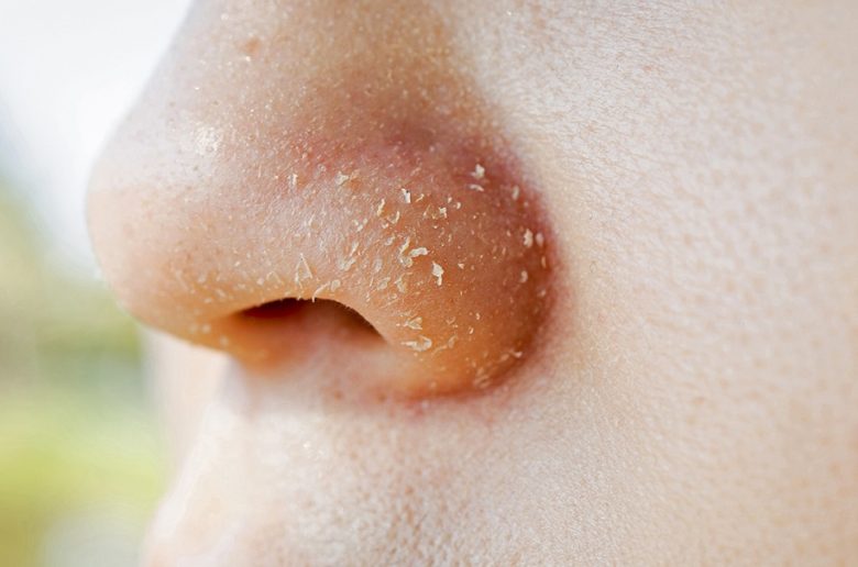 جفاف الجلد حول الأنف