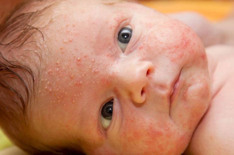 حب الشباب الوليدي