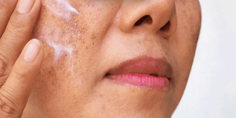  ما هي أهم الملاحظات التي يجب مراعاتها عند علاج فرط التصبغ؟