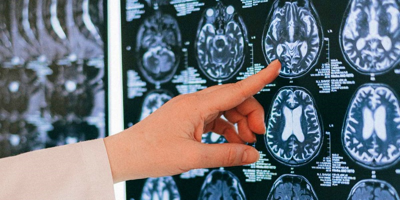 ما هي الآلية التشخيصية الصحيحة  لتشوهات الأوعية الدموية الدماغية؟