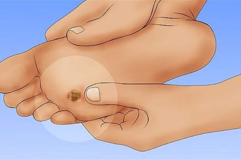 مسمار القدم مسمار القدم