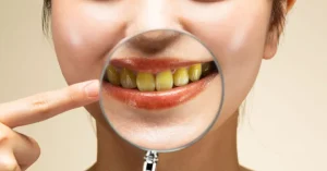 هل تدل تغيرات لون الأسنان على المعاناة من مشكلات صحية ؟