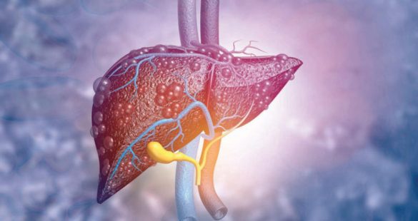 هل يمكن أن يتحول مرض الكبد الدهني إلى قاتل خفي ؟