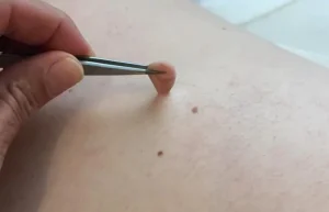 أسباب ظهور الزوائد الجلدية لدى مرضى السكري