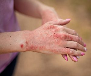 أضرار العلاج الكيميائي على الجلد