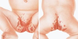 أعراض التهابات الحفاض لدى الأطفال