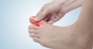 أعراض فرط حمض اليوريك في الدم