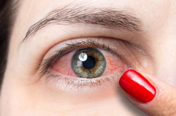 إحمرار العين الناجم عن ارتداء العدسات اللاصقة إحمرار العين الناجم عن ارتداء العدسات اللاصقة
