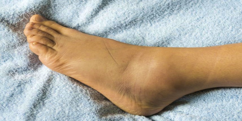 إصابة الكاحلين والقدمين بالتورم