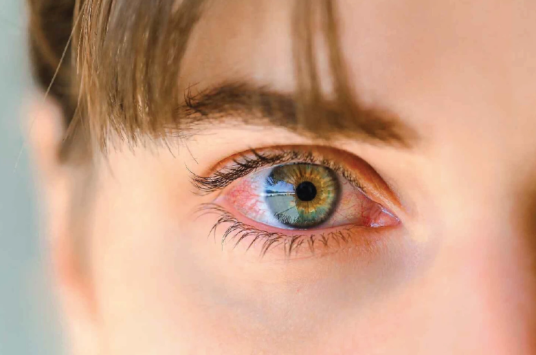 التهاب العنبية