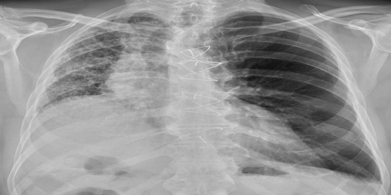 الطرق المعنية بتشخيص الـ IPF