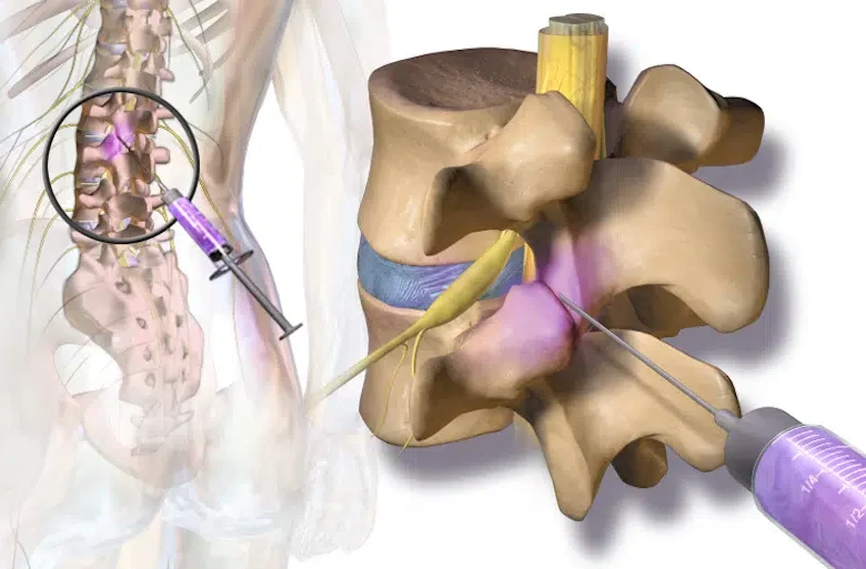 العلاج الحراري للإنزلاق الغضروفي