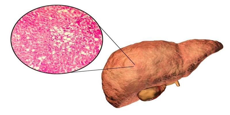 الكبد الدهني غير الكحولي (NAFLD)
