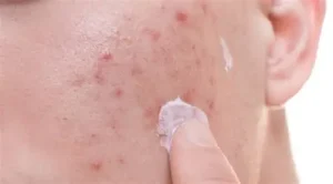 المضادات الحيوية الموضعية
