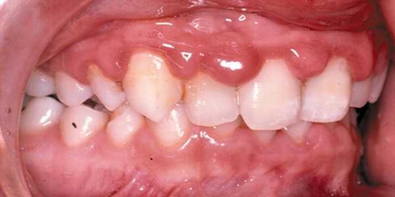 الورم الحليمي اللثوي