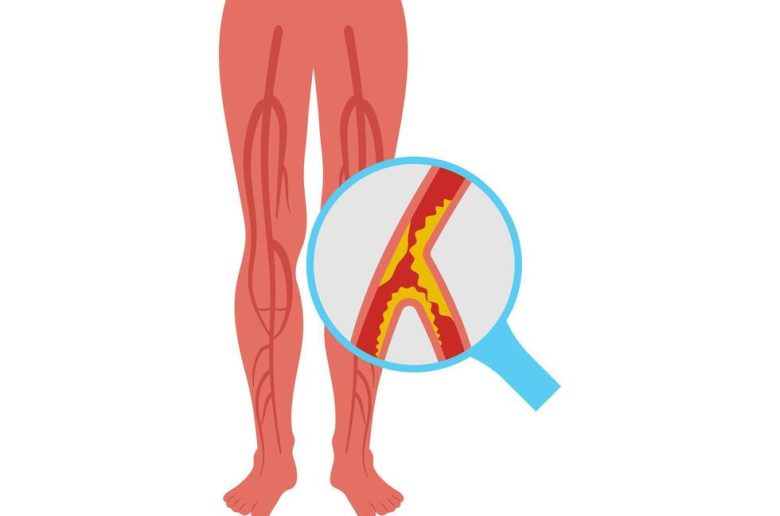 انسداد الشريان الفخذي