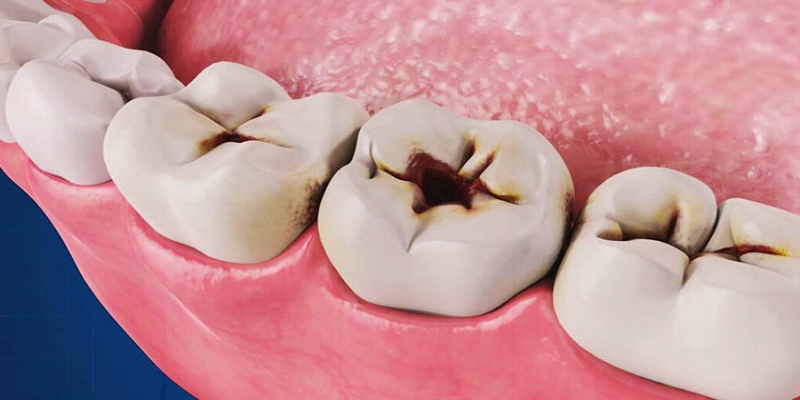 تسوس وتآكل الأسنان