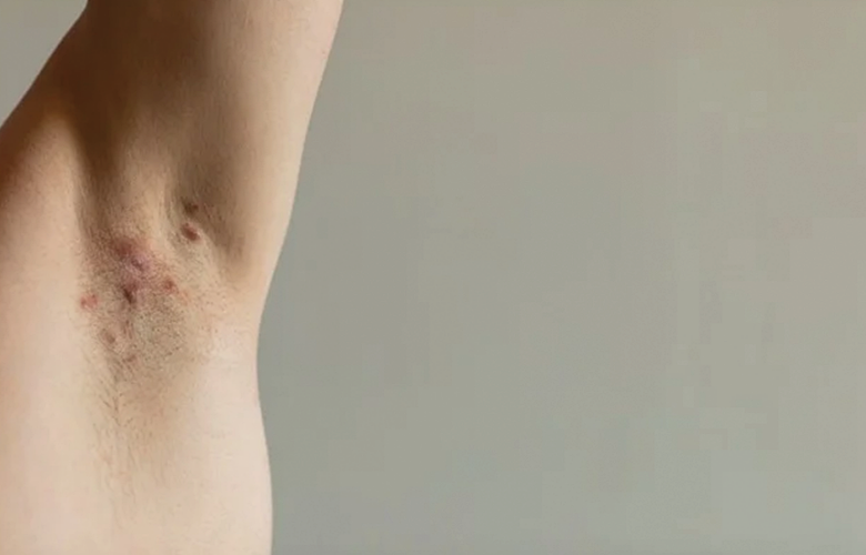 طرق علاجية للتغلب على التهاب الغدد العرقية القيحي