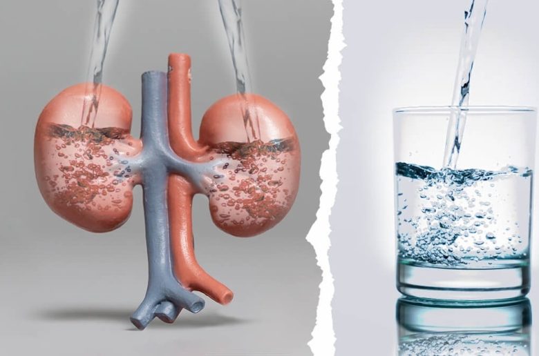 كمية الماء المناسبة للتخلص من حصوات الكلى