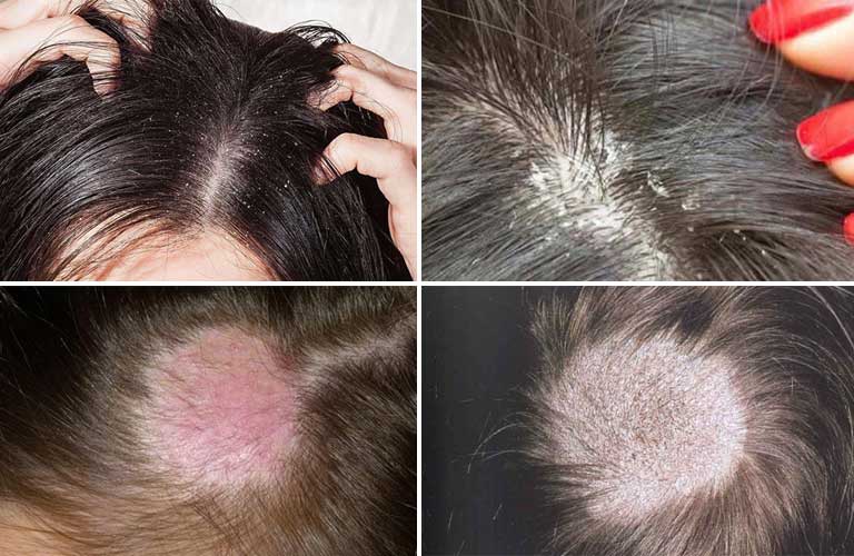 كيف نميز بين تينيا الشعر والثعلبة البقعية؟