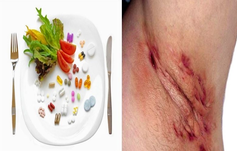 ما هي المكملات الغذائية التي تدعم علاج التهاب الغدد العرقية القيحية؟