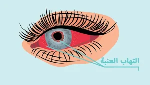 ماذا يعني التهاب العنبية ؟