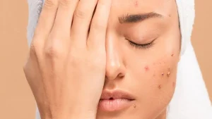  متى يصف الطبيب كبسولات المضاد الحيوي الفموية لعلاج حب الشباب ؟