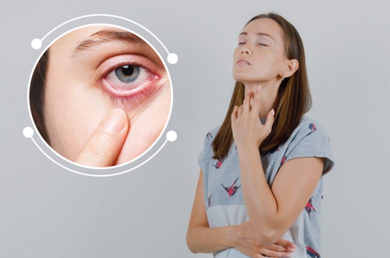 مرض العين الدرقية