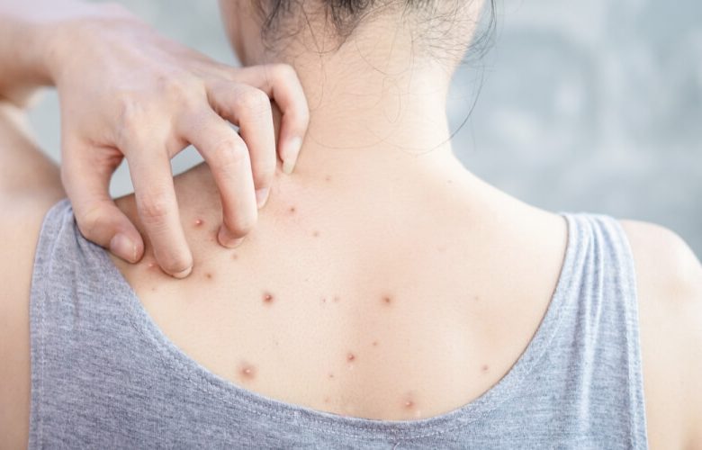 مشكلة حبوب الظهر لدى النساء مشكلة حبوب الظهر لدى النساء