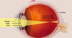 أخطاء الإنكسار