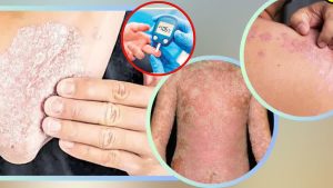 أسباب معاناة مرضى السكري من الحكة