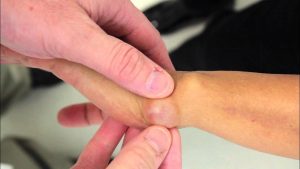 أعراض الكيس الدهني في معصم اليد