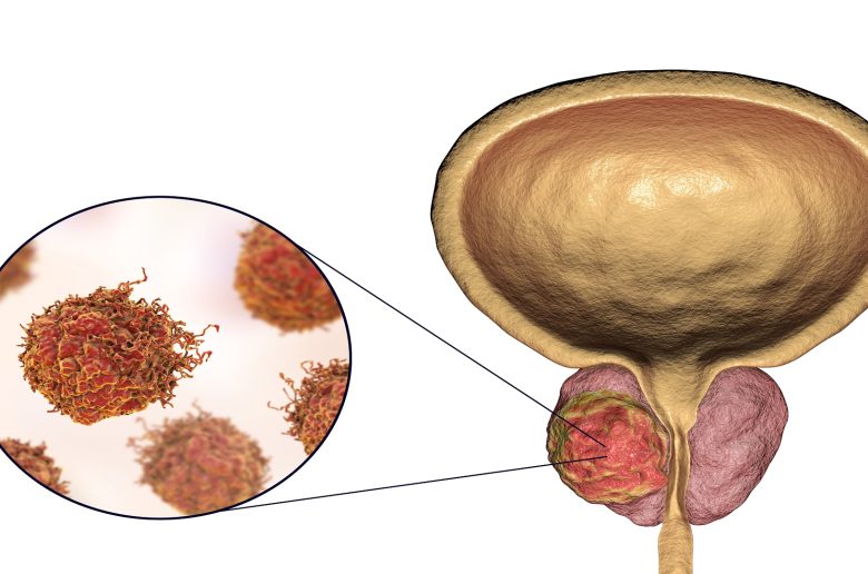 أفضل البذور للوقاية من سرطان البروستاتا