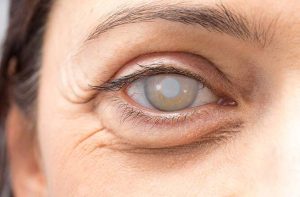 إعتام عدسة العين