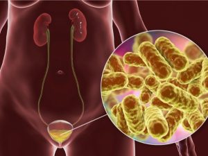 إلتهاب المسالك البولية