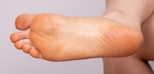 اصفرار باطن القدمين